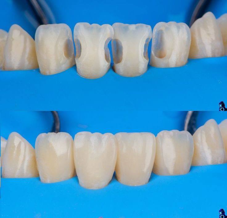 تفاوت کاربرد کامپوزیت های قدامی و خلفی