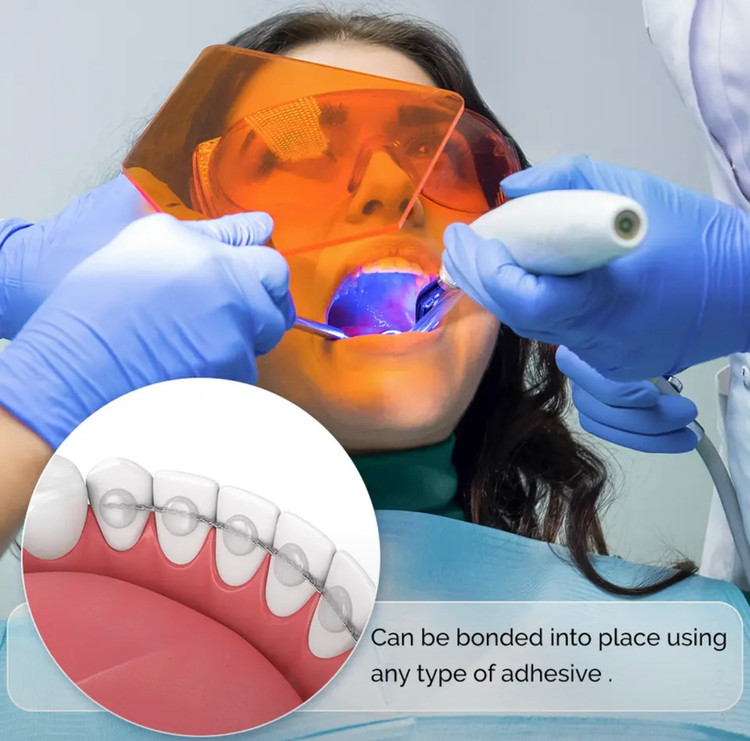 سیم ریتینر ارتودنسی نصب شده پشت دندانهای قدامی فک پایین