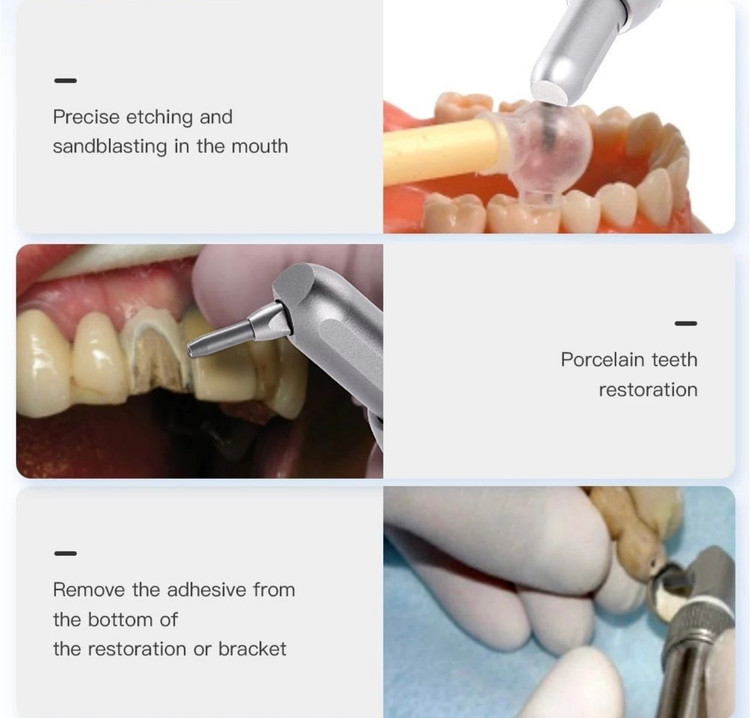 دندانپزشک در حال استفاده از سندبلاستر برای آمادهسازی سطح کراون قبل از سمانگذاری
