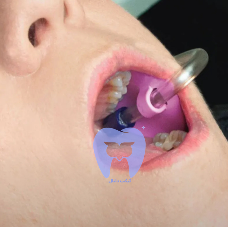 دندانپزشک در حال ترمیم دندان (بدون دستیار) که لوله ساکشن توسط نگهدارنده در موقعیت ثابت قرار گرفته است.