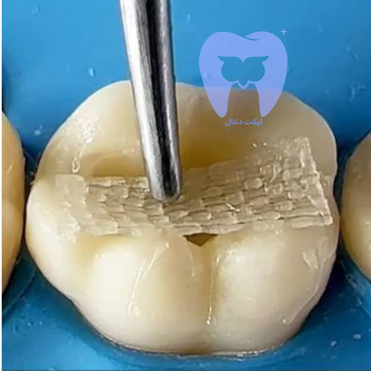 تصویر شماتیک ساختار بافتهشده الیاف UHMWPE نوار Ribbond THM که آماده جذب رزین است.