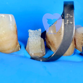 ترمیم کلاس IV دندان قدامی که نوار Ribbond THM برای تقویت لبه اینسایزال در لایههای کامپوزیت قرار گرفته است.