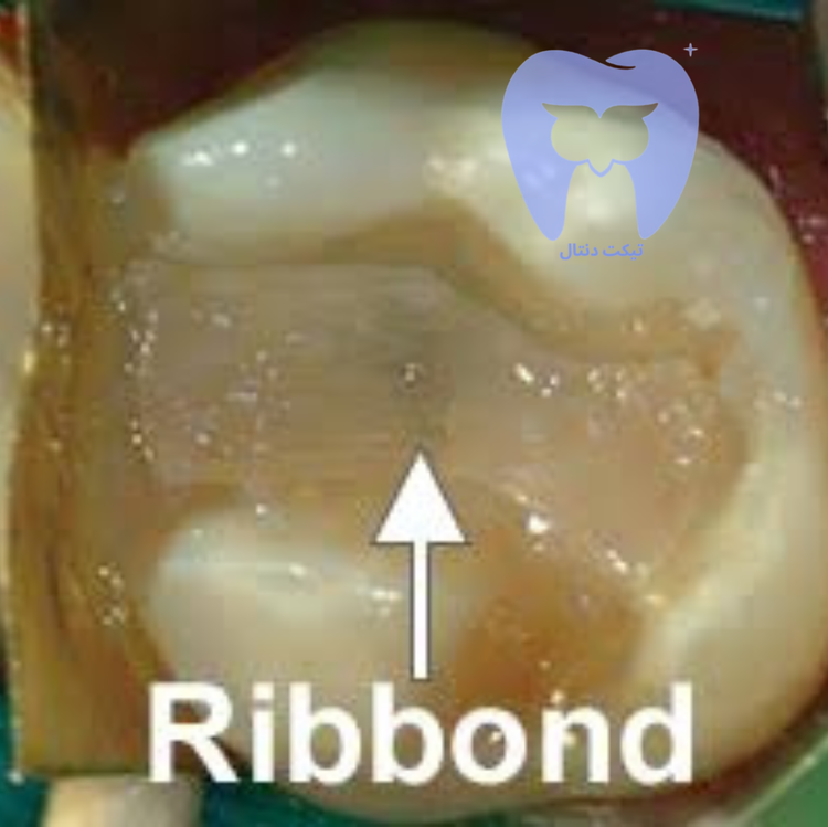نمای نزدیک از فایبر Ribbond THM که پس از آغشتهسازی با رزین، کاملاً شفاف و نامرئی شده است.