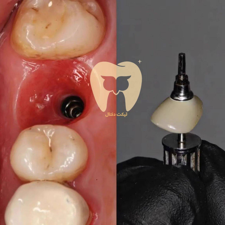 ابزار فرم دهنده بافت نرم لثه Gingival Cuff